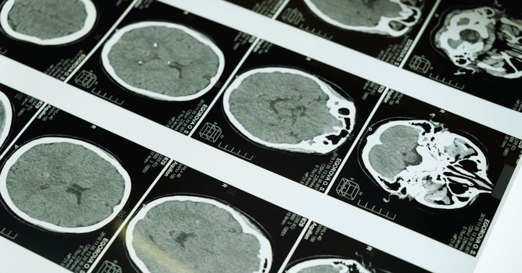 What is Neurologic Music Therapy